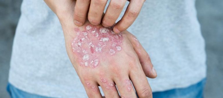 Examples Of Fungal Infections In Humans